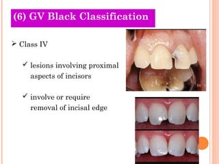 (6) GV Black
Old Theories Classification

 Class IV

    lesions involving proximal
     aspects of incisors

    involve or require
     removal of incisal edge
 