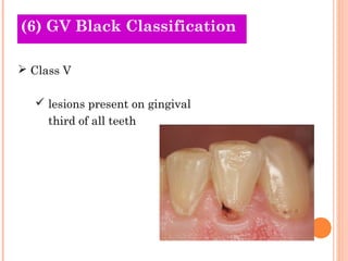 (6) GV Black
Old Theories Classification

 Class V

   lesions present on gingival
     third of all teeth
 