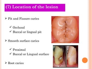 (7) Location
Old Theoriesof the lesion

 Pit and Fissure caries

    Occlusal
    Buccal or lingual pit

 Smooth surface caries

    Proximal
    Buccal or Lingual surface

 Root caries
 