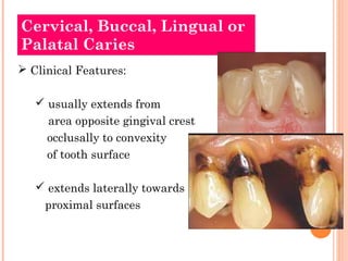 Cervical, Buccal, Lingual or
Palatal Caries
 Clinical Features:

    usually extends from
     area opposite gingival crest
     occlusally to convexity
     of tooth surface

    extends laterally towards
     proximal surfaces
 