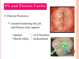 Pit and Fissure Caries

 Clinical Features:

    enamel bordering the pit
     and fissure may appear

      • opaque         as it becomes
      • bluish white   undermined
 