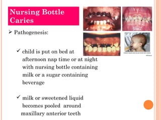 Nursing Bottle
Caries
 Pathogenesis:


    child is put on bed at
     afternoon nap time or at night
     with nursing bottle containing
     milk or a sugar containing
     beverage

    milk or sweetened liquid
    becomes pooled around
    maxillary anterior teeth
 
