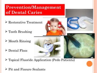 Prevention/Management
of Dental Caries

 Restorative Treatment

 Tooth Brushing

 Mouth Rinsing

 Dental Floss

 Topical Fluoride Application (Pedo Patients)

 Pit and Fissure Sealants
 