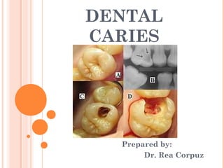 DENTAL
CARIES




  Prepared by:
       Dr. Rea Corpuz
 