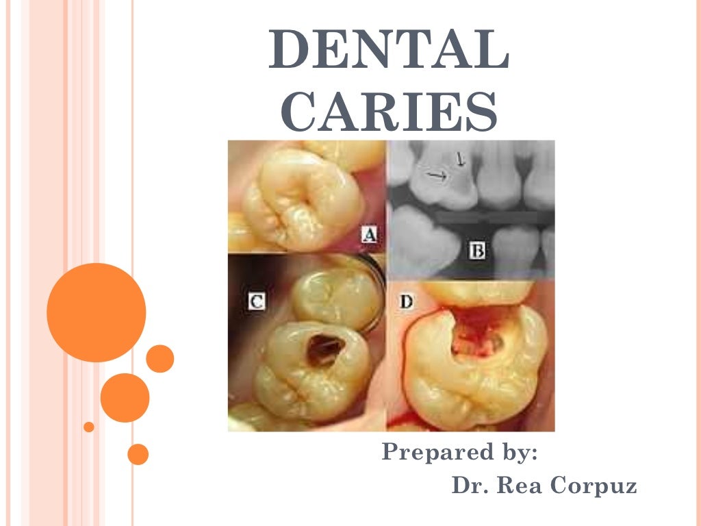 Dental caries