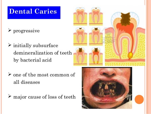Dental caries Dental caries