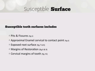 Susceptible Surface


Susceptible tooth surfaces includes


  !   Pits  &  Fissures  (ﬁg.5)
  !   Approximal  Enamel  cervical  to  contact  point  (ﬁg.6)
  !   Exposed  root  surface  (fig.7 & 8)
  !   Margins  of  Restora4on  (ﬁg.6  &  9)
  !   Cervical  margins  of  tooth  (fig.10)
 