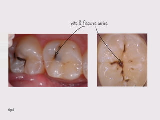 pits & fissures caries




fig.5
 