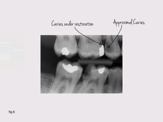Caries under restoration   Approximal Caries




fig.6
 