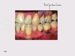Root Surface Caries




fig.8
 