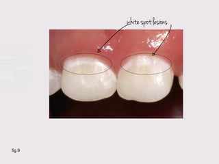 white spot lesions




fig.9
 