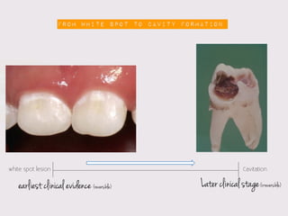 From white spot to cavity formation




white spot lesion                                                   Cavitation


    earliest clinical evidence (reversible)       Later clinical stage (irreversible)
 