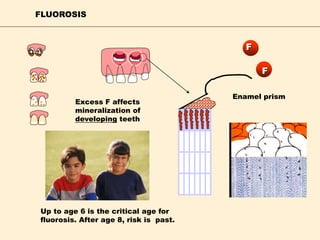 FLUOROSIS
F
F
Excess F affects
mineralization of
developing teeth
Up to age 6 is the critical age for
fluorosis. After age 8, risk is past.
Enamel prism
 