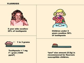 FLUOROSIS
Children under 2
years swallow 50%
of toothpaste
5 year olds swallow
25% of toothpaste
Toothpaste = 1 mg
F / gram (1000
ppmF)
1 to 3 grams
“pea” size amount (0.5g) is
recommenred for fluorosis
susceptible children.
 