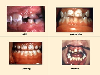 moderate
severe
mild
pitting
 