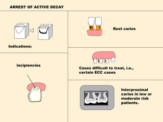 ARREST OF ACTIVE DECAY
incipiencies
Root caries
Indications:
Cases difficult to treat, i.e.,
certain ECC cases
Interproximal
caries in low or
moderate risk
patients.
 