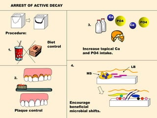 ARREST OF ACTIVE DECAY
PO4PO4
Ca
Ca
MS
LB
1.
2.
3.
Increase topical Ca
and PO4 intake.
Encourage
beneficial
microbial shifts.
4.
Plaque control
Procedure:
Diet
control
 