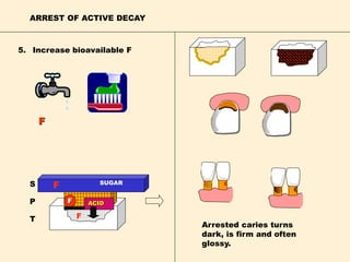 ARREST OF ACTIVE DECAY
5. Increase bioavailable F
F
Arrested caries turns
dark, is firm and often
glossy.
F
F
S
P
T F
ACID
SUGAR
 