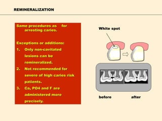 REMINERALIZATION
Same procedures as for
arresting caries.
Exceptions or additions:
1. Only non-cavitated
lesions can be
remineralized.
2. Not recommended for
severe of high caries risk
patients.
3. Ca, PO4 and F are
administered more
precisely.
White spot
before after
 