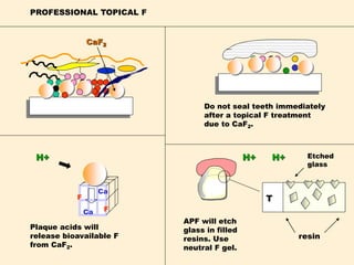 PROFESSIONAL TOPICAL F
CaF2
Do not seal teeth immediately
after a topical F treatment
due to CaF2.
APF will etch
glass in filled
resins. Use
neutral F gel.
T
H+
Plaque acids will
release bioavailable F
from CaF2.
F
F
Ca
Ca
resin
Etched
glass
H+ H+
 