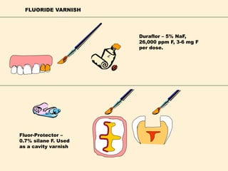 FLUORIDE VARNISH
Duraflor – 5% NaF,
26,000 ppm F, 3-6 mg F
per dose.
Fluor-Protector –
0.7% silane F. Used
as a cavity varnish
 