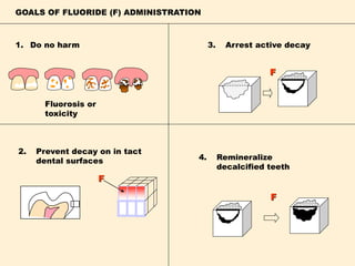 GOALS OF FLUORIDE (F) ADMINISTRATION
Do no harm
Prevent decay on in tact
dental surfaces
F
F
Arrest active decay
Remineralize
decalcified teeth
1.
2.
3.
4.
F
Fluorosis or
toxicity
 