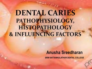 Anusha Sreedharan
SRM KATTANKULATHUR DENTAL COLLEGE
DENTAL CARIES
PATHOPHYSIOLOGY,
HISTOPATHOLOGY
& INFLUENCING FACTORS
 