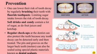 Dental caries | PDF