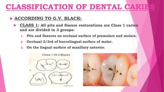 CLASSIFICATION OF DENTAL CARIES
 ACCORDING TO G.V. BLACK:
 CLASS 1: All pits and fissure restorations are Class 1 caries
and are divided in 3 groups:
1. Pits and fissures on occlusal surface of premolars and molars.
2. Occlusal 2/3rd of buccolingual surface of molar.
3. On the lingual surface of maxillary anterior.
 
