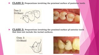  CLASS 2: Preparations involving the proximal surface of posterior teeth.
 CLASS 3: Preparations involving the proximal surface pf anterior teeth
that does not include the incisal surfaces.
 