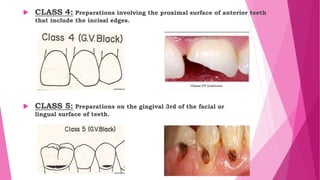  CLASS 4: Preparations involving the proximal surface of anterior teeth
that include the incisal edges.
 CLASS 5: Preparations on the gingival 3rd of the facial or
lingual surface of teeth.
 