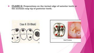  CLASS 6: Preparations on the incisal edge of anterior teeth or
the occlusal cusp tip of posterior teeth.
 