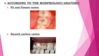  ACCORDING TO THE MORPHOLOGY/ANATOMY:
1. Pit and Fissure caries:
2. Smooth surface caries:
 