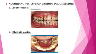  ACCORDING TO RATE OF CARIOUS PROGRESSION:
1. Acute caries:
2. Chronic caries:
 