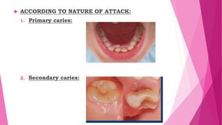  ACCORDING TO NATURE OF ATTACK:
1. Primary caries:
2. Secondary caries:
 
