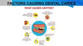 FACTORS CAUSING DENTAL CARIES
 