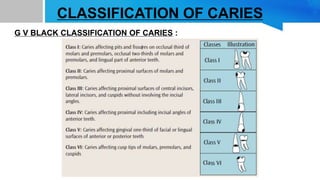 CLASSIFICATION OF CARIES
G V BLACK CLASSIFICATION OF CARIES :
 