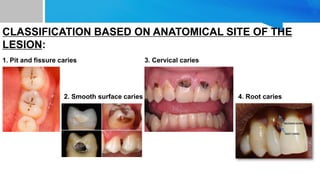 CLASSIFICATION BASED ON ANATOMICAL SITE OF THE
LESION:
1. Pit and fissure caries
2. Smooth surface caries
3. Cervical caries
4. Root caries
 