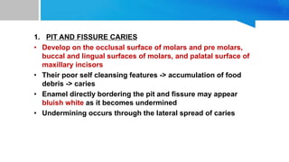 1. PIT AND FISSURE CARIES
• Develop on the occlusal surface of molars and pre molars,
buccal and lingual surfaces of molars, and palatal surface of
maxillary incisors
• Their poor self cleansing features -> accumulation of food
debris -> caries
• Enamel directly bordering the pit and fissure may appear
bluish white as it becomes undermined
• Undermining occurs through the lateral spread of caries
 