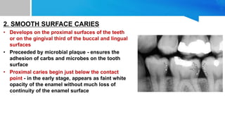 2. SMOOTH SURFACE CARIES
• Develops on the proximal surfaces of the teeth
or on the gingival third of the buccal and lingual
surfaces
• Preceeded by microbial plaque - ensures the
adhesion of carbs and microbes on the tooth
surface
• Proximal caries begin just below the contact
point - in the early stage, appears as faint white
opacity of the enamel without much loss of
continuity of the enamel surface
 
