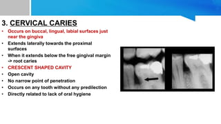 3. CERVICAL CARIES
• Occurs on buccal, lingual, labial surfaces just
near the gingiva
• Extends laterally towards the proximal
surfaces
• When it extends below the free gingival margin
-> root caries
• CRESCENT SHAPED CAVITY
• Open cavity
• No narrow point of penetration
• Occurs on any tooth without any predilection
• Directly related to lack of oral hygiene
 
