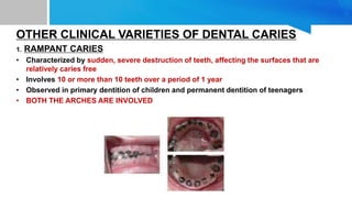 OTHER CLINICAL VARIETIES OF DENTAL CARIES
1. RAMPANT CARIES
• Characterized by sudden, severe destruction of teeth, affecting the surfaces that are
relatively caries free
• Involves 10 or more than 10 teeth over a period of 1 year
• Observed in primary dentition of children and permanent dentition of teenagers
• BOTH THE ARCHES ARE INVOLVED
 