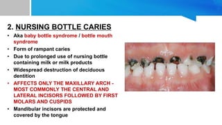 2. NURSING BOTTLE CARIES
• Aka baby bottle syndrome / bottle mouth
syndrome
• Form of rampant caries
• Due to prolonged use of nursing bottle
containing milk or milk products
• Widespread destruction of deciduous
dentition
• AFFECTS ONLY THE MAXILLARY ARCH -
MOST COMMONLY THE CENTRAL AND
LATERAL INCISORS FOLLOWED BY FIRST
MOLARS AND CUSPIDS
• Mandibular incisors are protected and
covered by the tongue
 