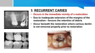3. RECURRENT CARIES
• Occurs in the immediate vicinity of a restoration
• Due to inadequate extension of the margins of the
restoration - favours the retention of debris
• Occur beneath the restoration where carious dentin
is not removed properly prior to restoration
 