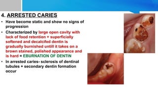 4. ARRESTED CARIES
• Have become static and show no signs of
progression
• Characterized by large open cavity with
lack of food retention + superficially
softened and decalcifed dentin is
gradually burnished untill it takes on a
brown stained, polished appearance and
is hard = EBURNATION OF DENTIN
• In arrested caries- sclerosis of dentinal
tubules + secondary dentin formation
occur
 