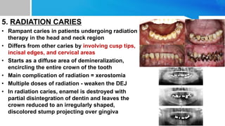 5. RADIATION CARIES
• Rampant caries in patients undergoing radiation
therapy in the head and neck region
• Differs from other caries by involving cusp tips,
incisal edges, and cervical areas
• Starts as a diffuse area of demineralization,
encircling the entire crown of the tooth
• Main complication of radiation = xerostomia
• Multiple doses of radiation - weaken the DEJ
• In radiation caries, enamel is destroyed with
partial disintegration of dentin and leaves the
crown reduced to an irregularly shaped,
discolored stump projecting over gingiva
 