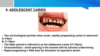 6. ADOLESCENT CARIES
• Two chronological periods when acute, rapidly progressing caries is observed:
A.4-8yrs
B.11-18yrs
• The latter period is referred to as the adolescent caries {11-18yrs}
• Characteristics - small opening in the enamel with its extreme undermining
• Rapid progressing = little time for formation of reparative dentin
 