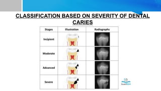 CLASSIFICATION BASED ON SEVERITY OF DENTAL
CARIES
 