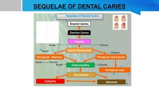 SEQUELAE OF DENTAL CARIES
 