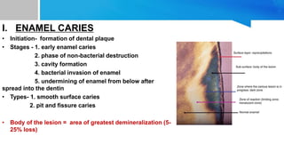 I. ENAMEL CARIES
• Initiation- formation of dental plaque
• Stages - 1. early enamel caries
2. phase of non-bacterial destruction
3. cavity formation
4. bacterial invasion of enamel
5. undermining of enamel from below after
spread into the dentin
• Types- 1. smooth surface caries
2. pit and fissure caries
• Body of the lesion = area of greatest demineralization (5-
25% loss)
 